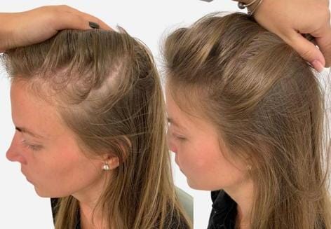 Causes and treatments for thinning hair in men and women