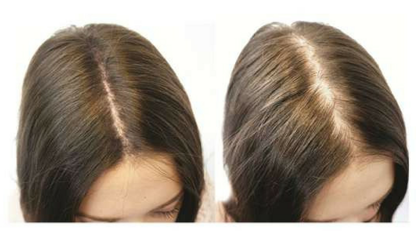 Understanding Female Hair Loss: Causes & Treatment - Jo Cosmetic |  Effective Thinning Hair & Scalp Solutions